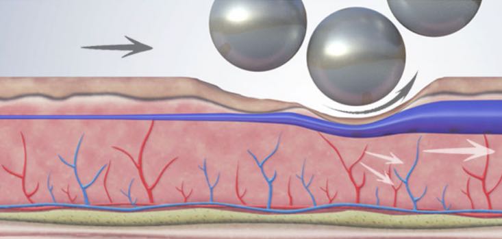 2. Lymphdrainage – Endospheres